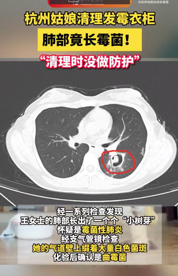杭州姑娘清理发霉衣柜肺部长霉菌 清理时没做好防护